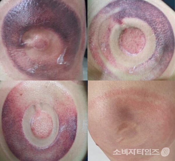 염증 정도 측정(자료제공:더뉴보스킨)