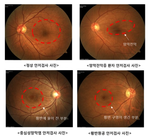 망막 안저검사 사진 / 자료제공 = 누네안과병원